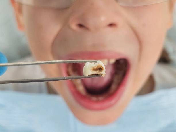 Best Emergency Root Canal Treatment in Edmonston, MD